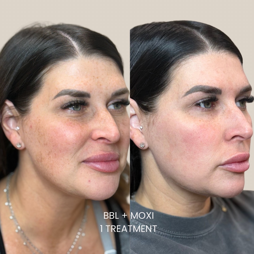 BBL Moxi Laser Combo - a