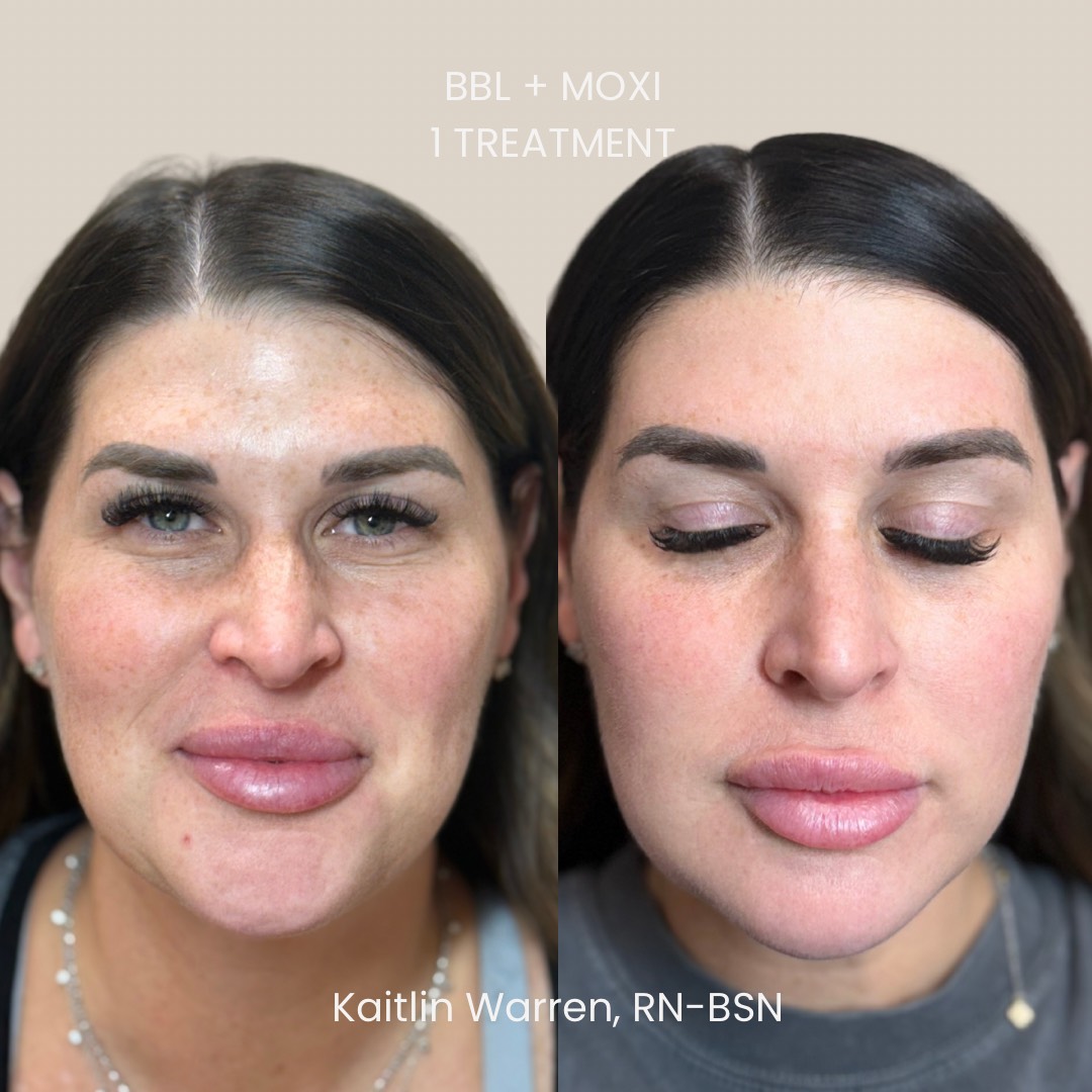 BBL Moxi Laser Combo - b