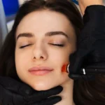 Performing the HydraFacial treatment with a handheld device on a clients forehead for exfoliation and cleansing.